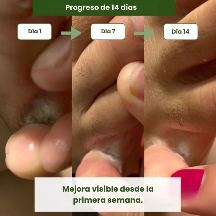 Jabón antimicótico