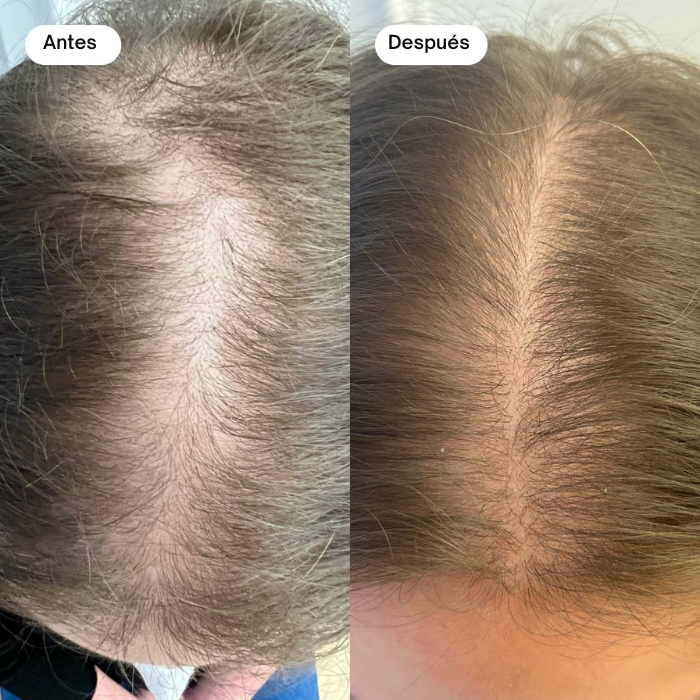 Suero capilar Botanical Boost Solución permanente para la caída del cabello