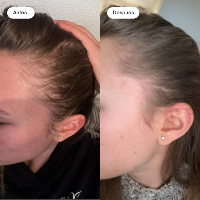 Suero capilar Botanical Boost Solución permanente para la caída del cabello