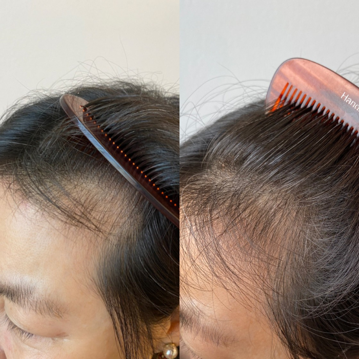 Suero capilar Botanical Boost Solución permanente para la caída del cabello