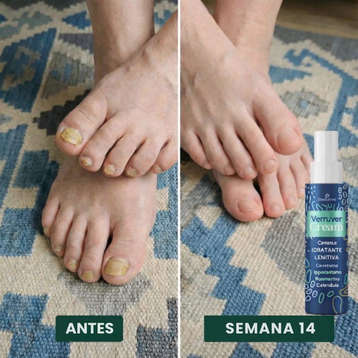 PAGA 1 LLEVA 2 Crema tratamiento para los hongos de uñas