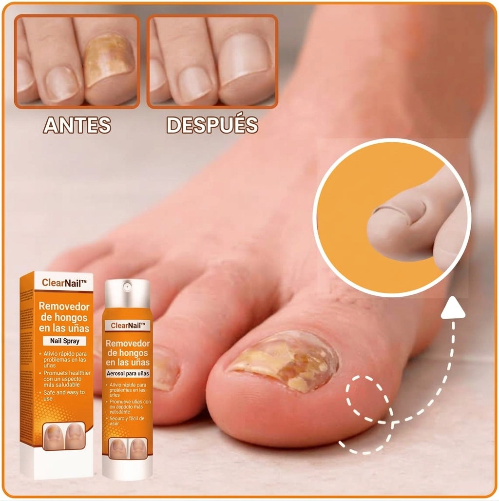 ClariNail Elimina los hongos de las uñas con un 98 % de efectividad