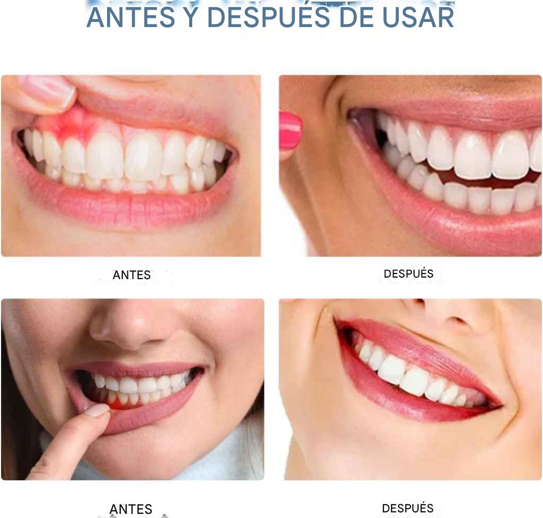 Spray Gum Protect revitaliza las encías y blanquea los dientes durante la primera semana.