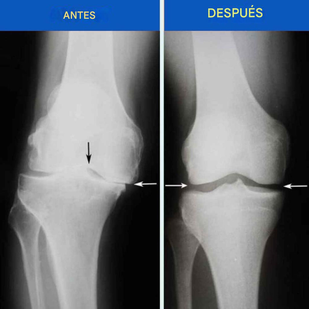 Rodillera con tecnología de alineación biomecánica realinea su articulación