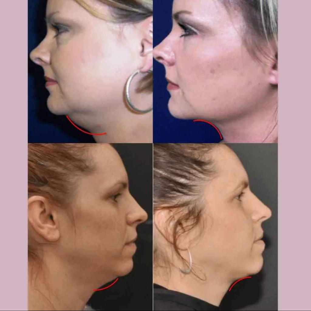 Mascarilla de contorno facial - Suaviza arrugas, papada y moldea el rostro